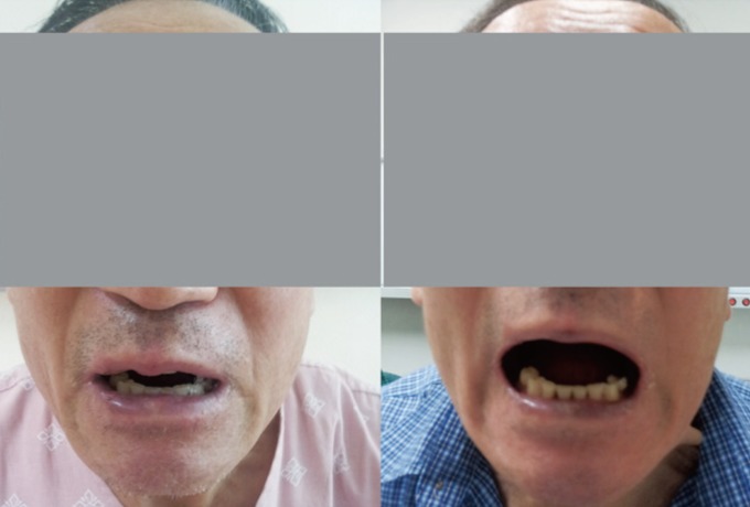 trismus in cephalic tetanus from a foot injury trismus