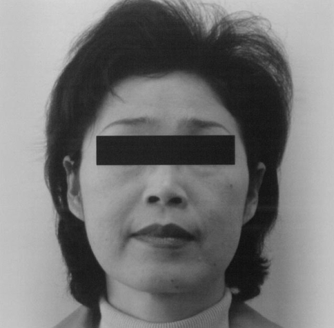 Ciprofloxacin side effects tingling in face Ciprofloxacin side effects tingling in face