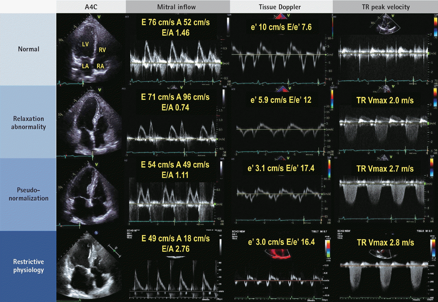 Case 43: Significant Spontaneous Echo Contrast In Left Ventricle (  DCM/Severe LV Dysfunction / LVEF : 15% in M- Mode / LVEF : 10% In Simpson's  Method., By Interesting cases in Echocardiography