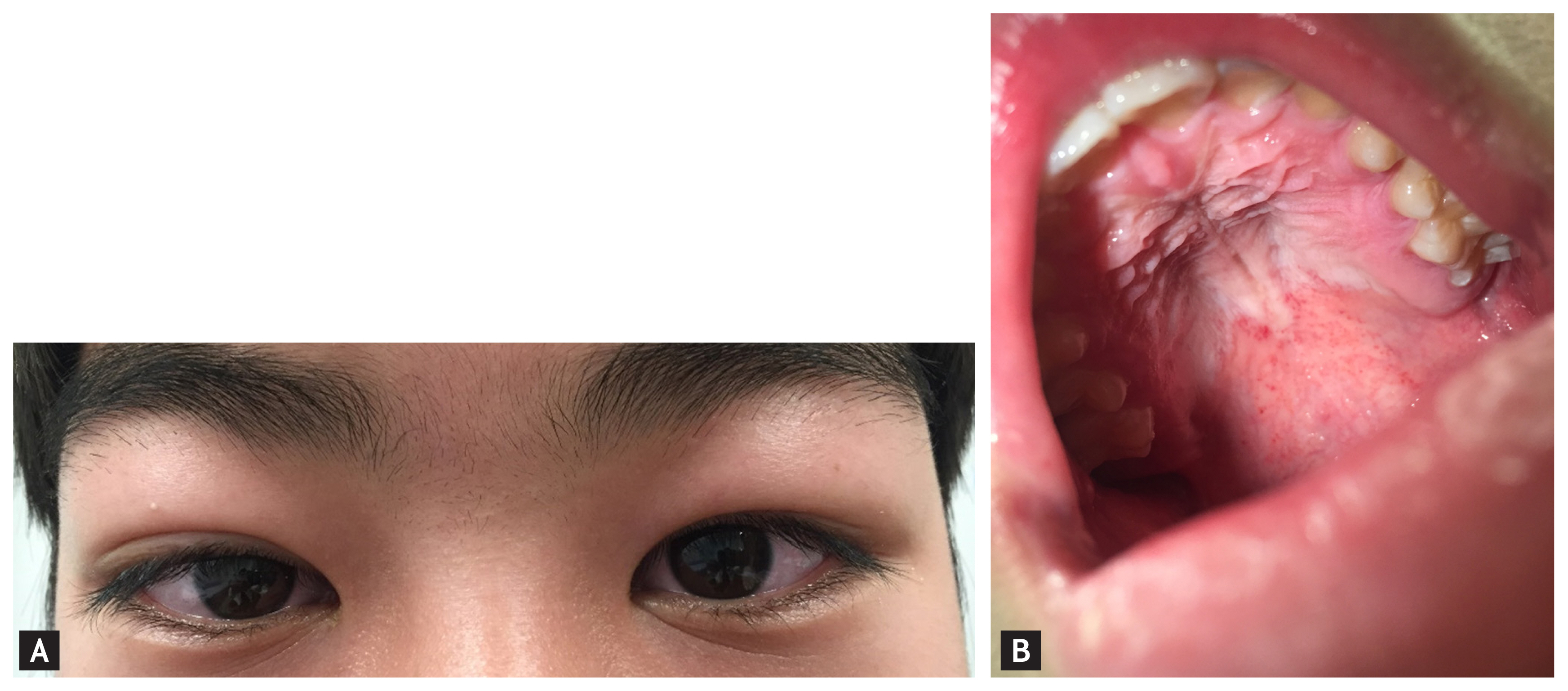 Petechiae palatal Hoarseness and