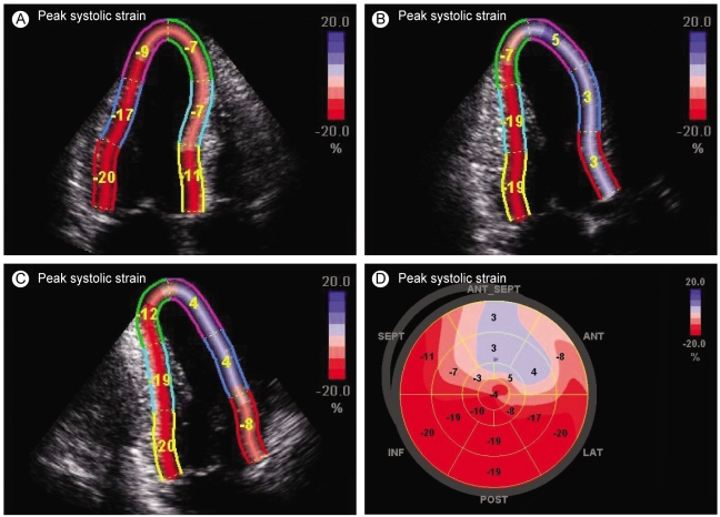 Baseline global longitudinal strain bull's-eye plot of the 16