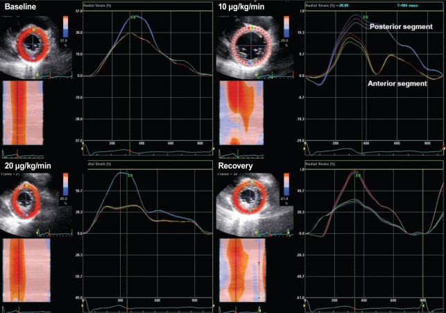 Abnormal left ventricular global longitudinal strain by speckle